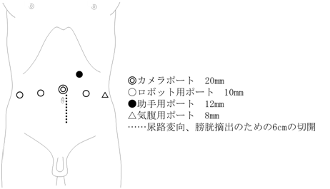 膀胱がん｜泌尿器科｜診療科・部門紹介｜ベルランド総合病院