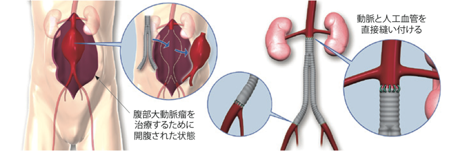 腹部大動脈瘤ステントグラフト内挿術の実際 - 健康/医学